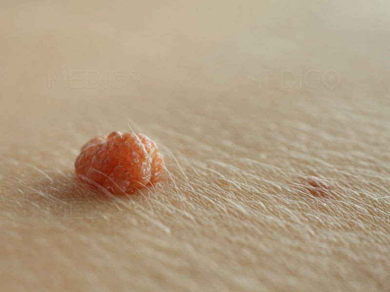 Nhiễm HPV ở nam giới gây ra Ung thư dương vật - ảnh 3