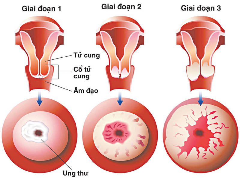 Xét nghiệm Pap giúp tầm soát ung thư cổ tử cung
