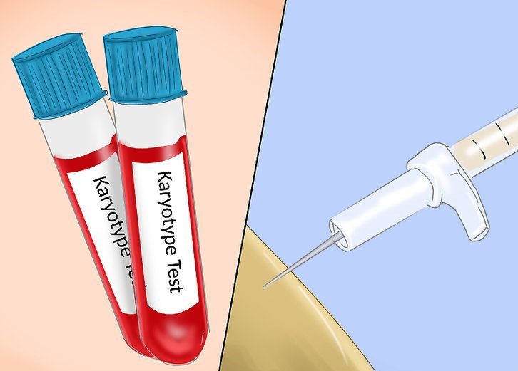 Xét nghiệm karyotype chẩn đoán Turner