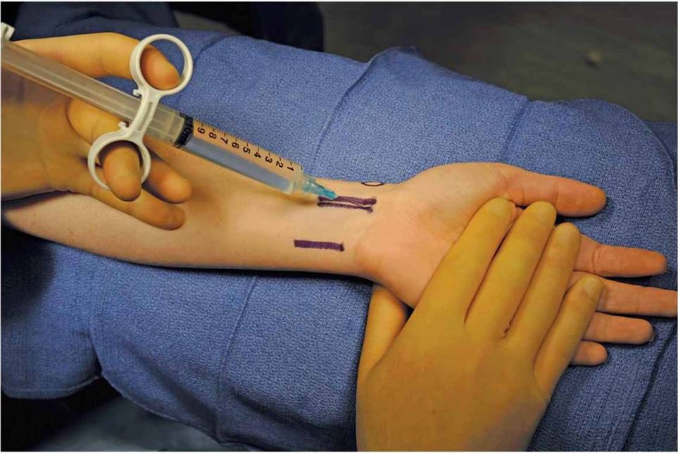 kỹ thuật gây tê thần kinh ngoại biên