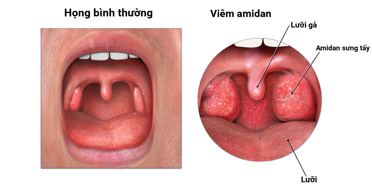 Amidan 2 bên sung đỏ