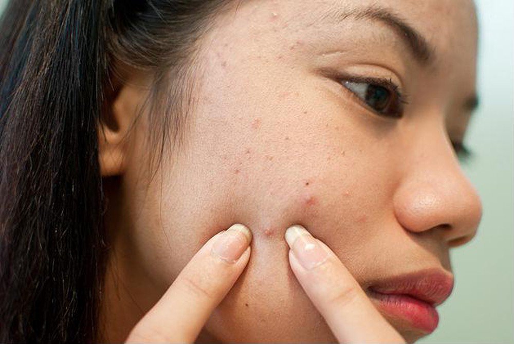 Nặn mụn xuất hiện mủ và nóng sốt