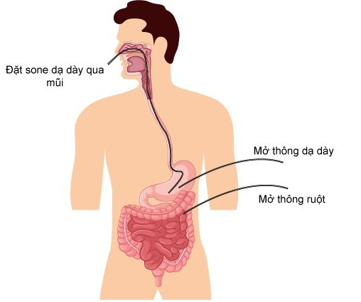 Mở thông dạ dày