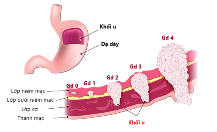 Các giai đoạn phát triển của bệnh ung thư dạ dày