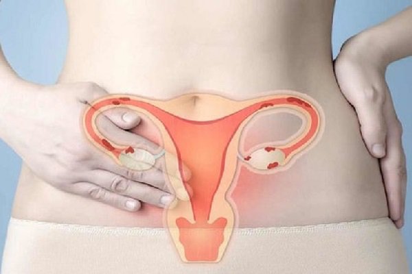HPV và ung thư cổ tử cung