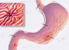 Điều trị hẹp miệng nối thực quản sau phẫu thuật - ảnh 2