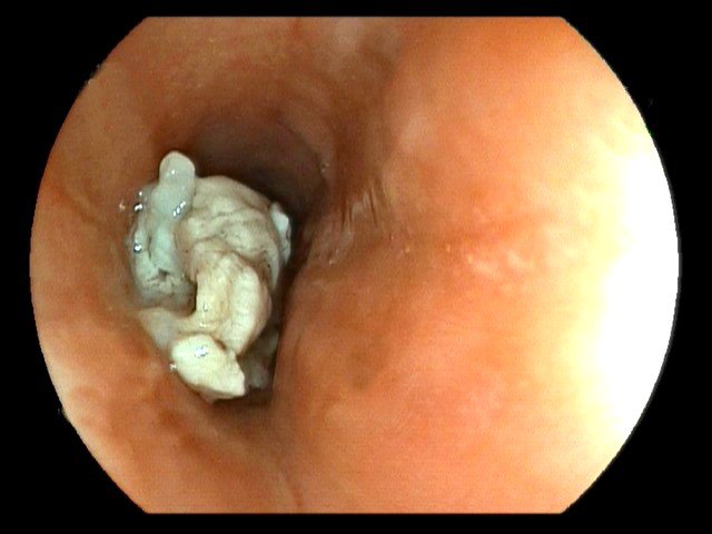 Những điều cần lưu ý khi soi thực quản bằng ống soi mềm kiểm tra gắp dị vật - ảnh 2
