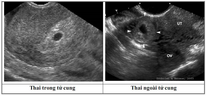 Thai ngoài tử cung