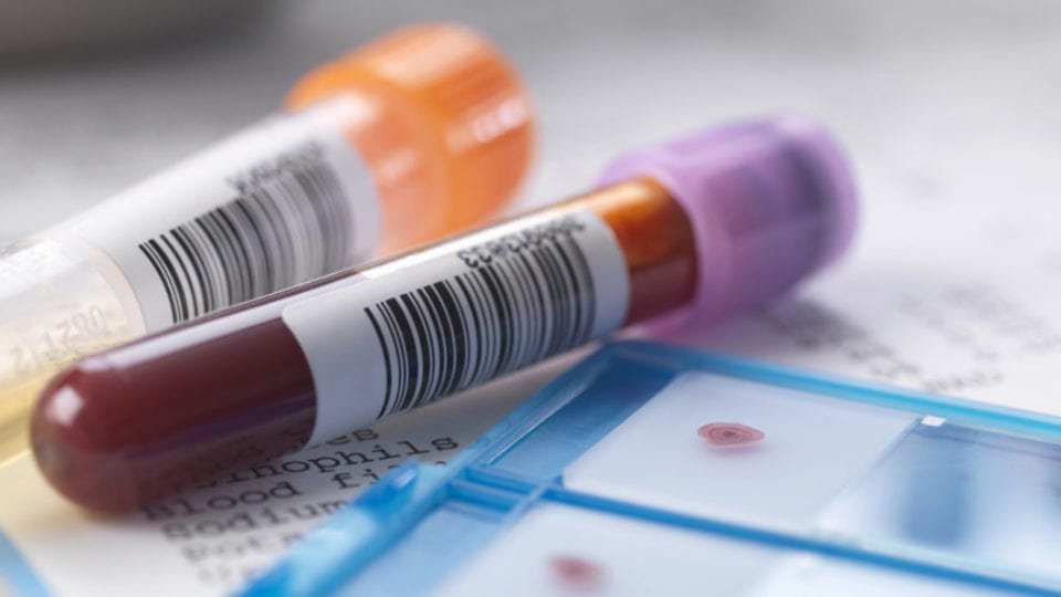 Chỉ số xét nghiệm máu Cyfra 21-1