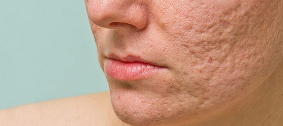 Phẫu thuật điều trị sẹo lồi do mụn