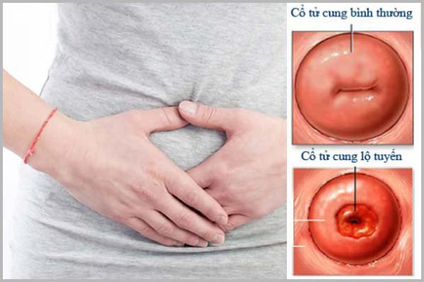 Viêm lộ tuyến cổ tử cung