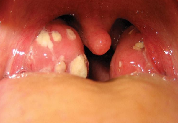 Viêm Amidale hốc mủ