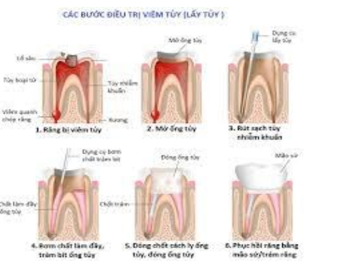 Các bước điều trị viêm tủy