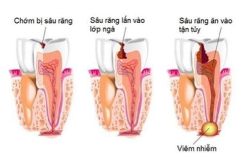 răng sâu vào tủy