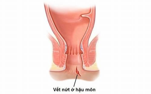 Đại tiện máu tươi dấu hiệu bị bệnh gì? và cách điều trị - ảnh 2