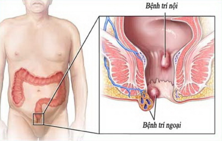 Đại tiện máu tươi dấu hiệu bị bệnh gì? và cách điều trị - ảnh 1