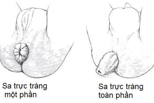 Đại tiện máu tươi dấu hiệu bị bệnh gì? và cách điều trị - ảnh 3