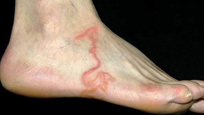 Bệnh giun lươn: Nguyên nhân, triệu chứng, cách phòng chống