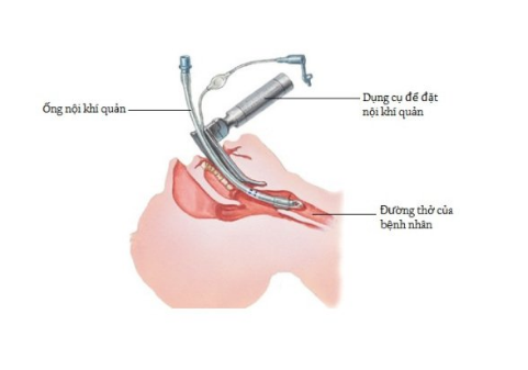 Gây mê nội khí quản