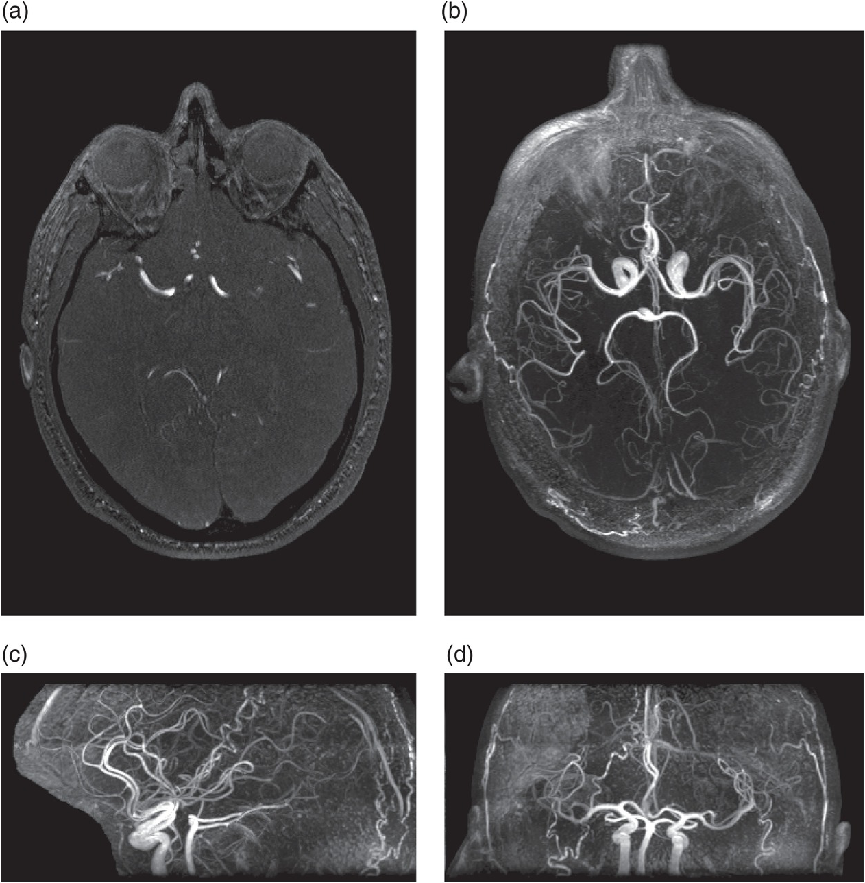 Quy trình chụp cộng hưởng từ tĩnh mạch không tiêm thuốc đối quang từ