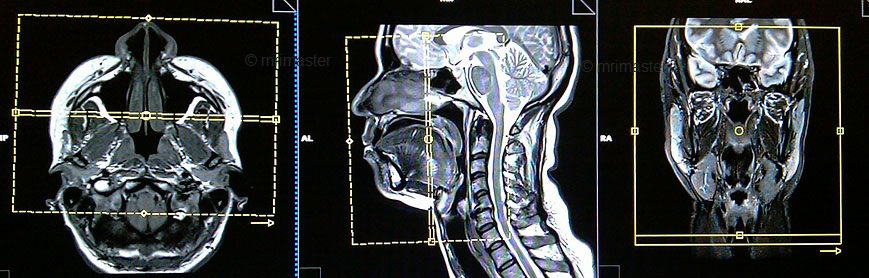 MRI mặt cổ