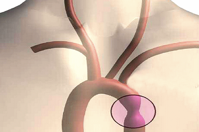 Hẹp eo động mạch chủ