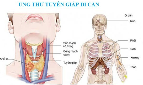 Ung thư tuyến giáp di căn