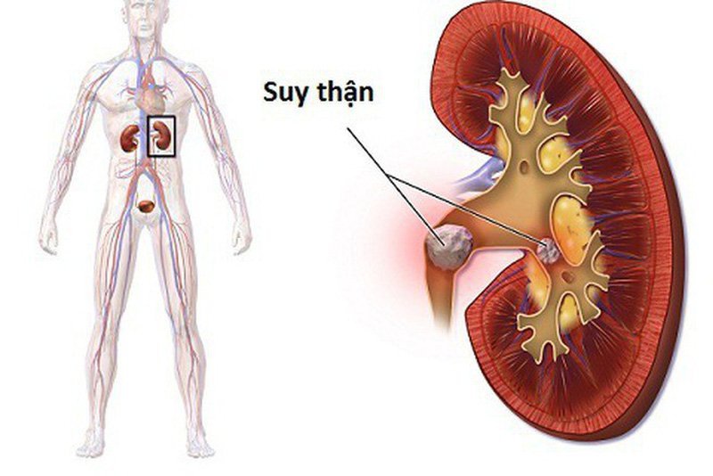 Cần thận trọng khi dùng thuốc đối quang đối với bệnh nhân mắc suy thận nặng