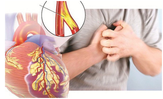 Xơ vữa động mạch