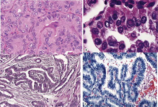 Ung thư tuyến giáp dạng nhú