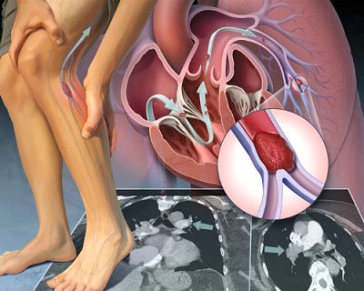 Bệnh nhân bị tắc động mạch chi dưới được chỉ định chụp MRI