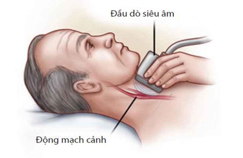 Siêu âm hệ động mạch cảnh và động mạch đốt sống trong các trường hợp nào? - ảnh 3