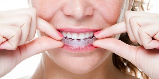 Tẩy trắng răng bằng máng