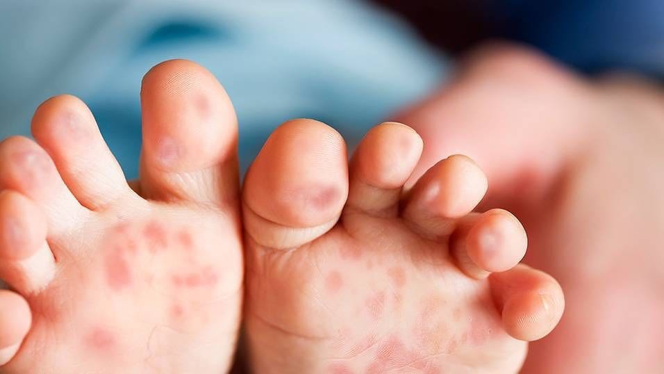 Trẻ xuất hiện những bọng nước đỏ khi mắc chân tay miệng