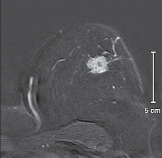 Tổn thương BIRADS 5
