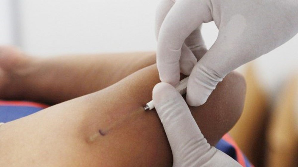 Cấy que tránh thai