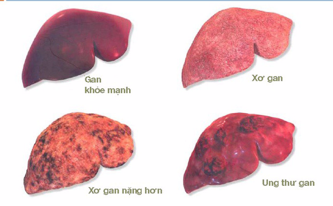 Các loại ung thư gan thường gặp
