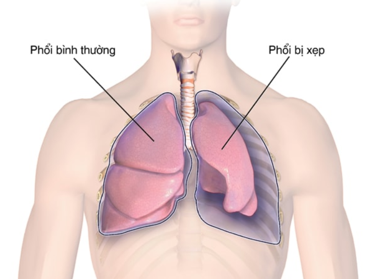 Xẹp phổi