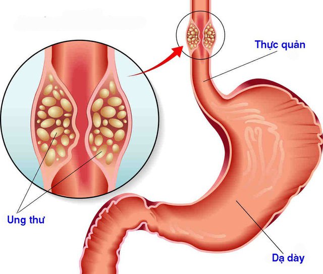 Các yếu tố nguy cơ của ung thư thực quản - ảnh 1