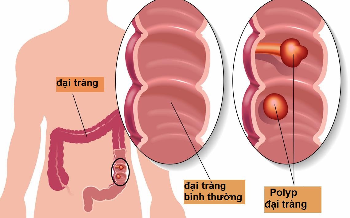 polyp đại tràng