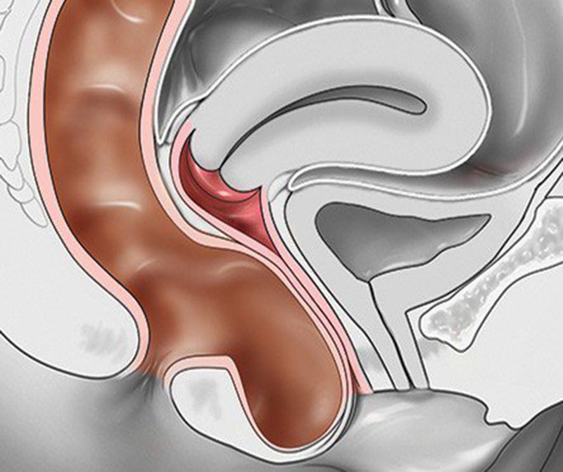Điều trị sa trực tràng bằng mổ nội soi - ảnh 1