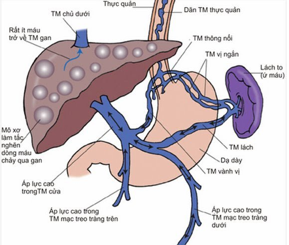 Hội chứng tăng áp lực tĩnh mạch cửa