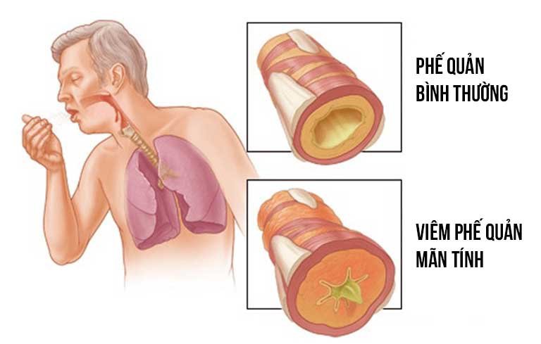Hướng dẫn trực quan về viêm phế quản