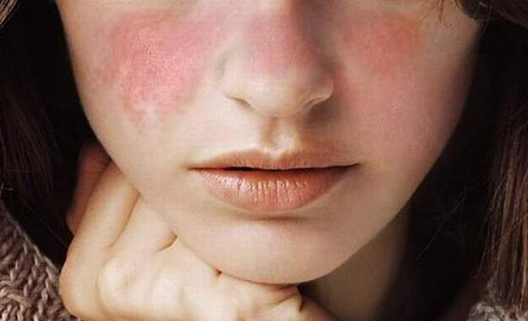 Bà bầu mắc bệnh lupus ban đỏ