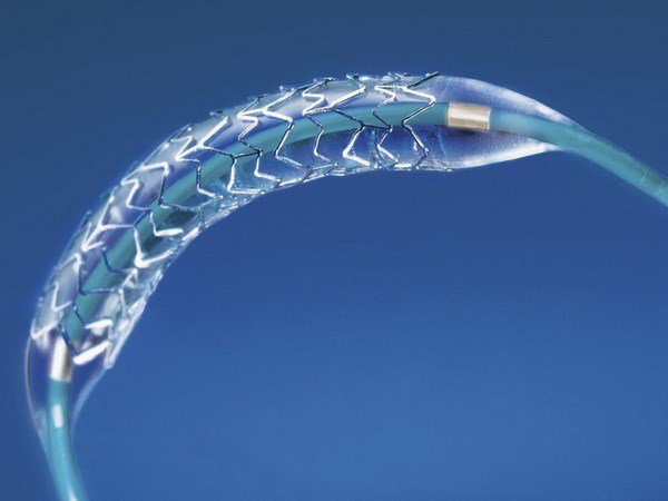 Đặt Stent là phương pháp điều trị hiệu quả, ít xâm lấn