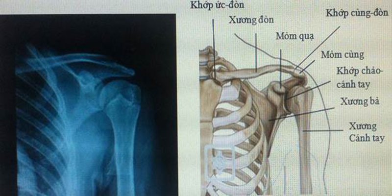 xương ức đòn