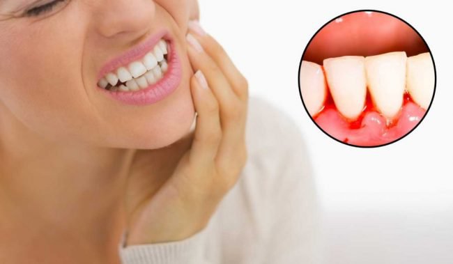 Hôn chỉ lây nhiễm khi cả 2 người bị chảy máu chân răng