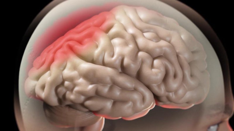 Trong quá trình phẫu thuật cần điều trị phù não cho bệnh nhân