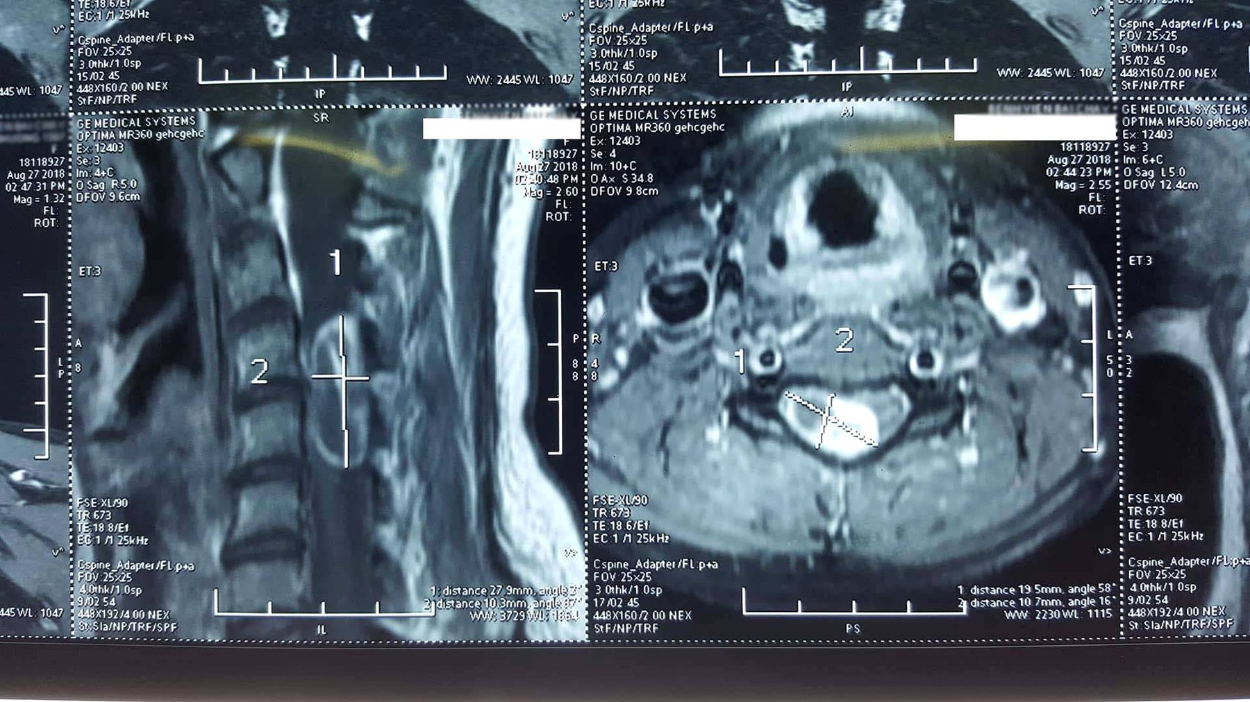 MRI cột sống cổ