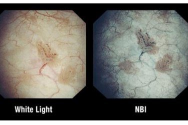 Narrow Band Imaging